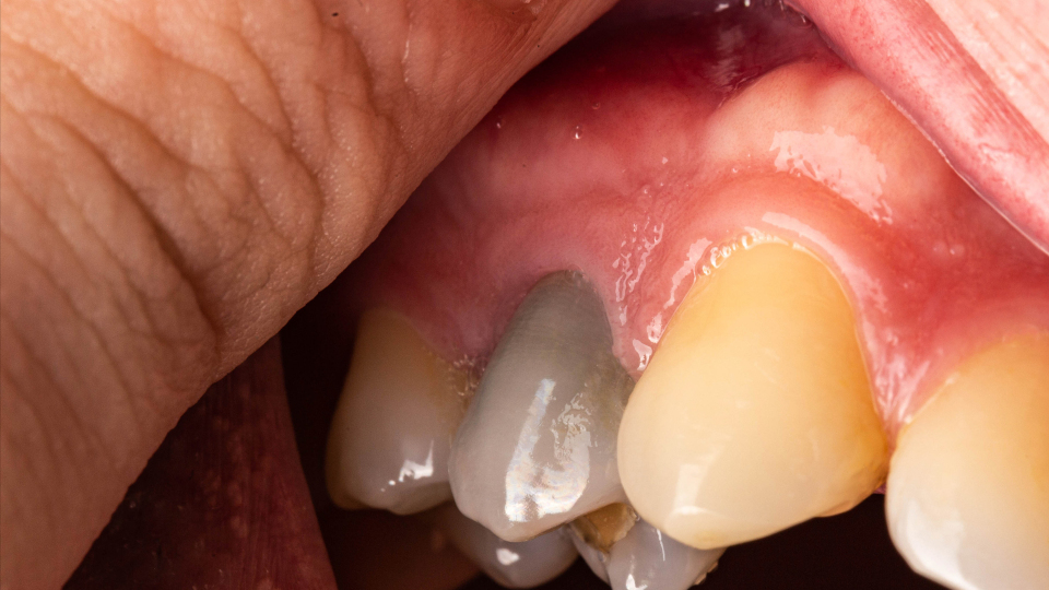 Wie sieht ein abgestorbener Zahn aus?